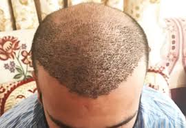 HAIR LOSS FOR MEN CLINIC IN RANCHI